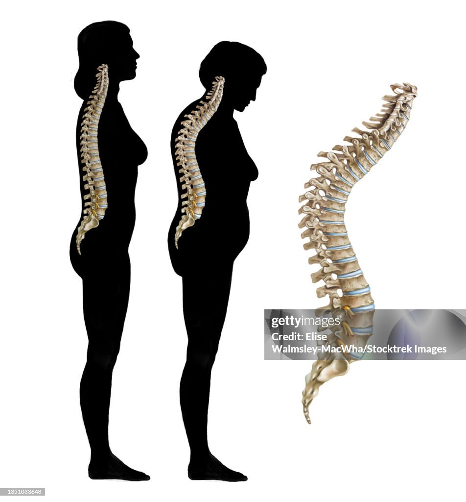 Normal spine compared to an osteoporotic spine on the silhouette of a woman.