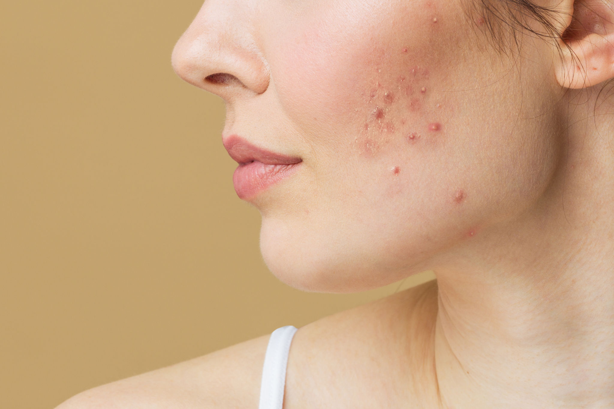 acne skin