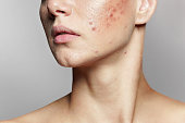 A young woman with bad skin. Skin with a lot of pimples. Acne disease, acne treatment