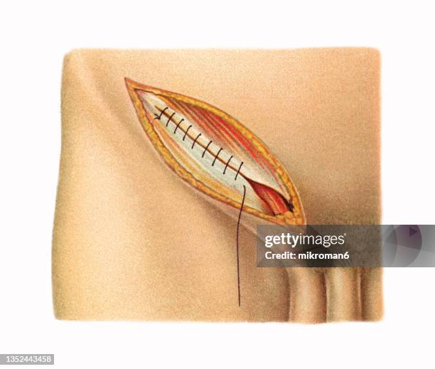 old chromolithograph illustration of surgical operation, open inguinal hernia repair (herniorrhaphy, hernioplasty) - hernia stockfoto's en -beelden