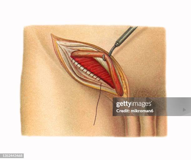 old chromolithograph illustration of surgical operation, open inguinal hernia repair (herniorrhaphy, hernioplasty) - hernia inguinal ストックフォトと画像