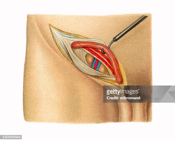 old chromolithograph illustration of surgical operation, open inguinal hernia repair (herniorrhaphy, hernioplasty) - hernia inguinal stock pictures, royalty-free photos & images