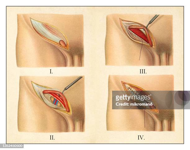 old chromolithograph illustration of surgical operation, open inguinal hernia repair (herniorrhaphy, hernioplasty) - aorta diagram stock-fotos und bilder
