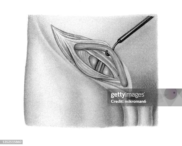 old chromolithograph illustration of surgical operation, inguinal hernia - hernia inguinal ストックフォトと画像