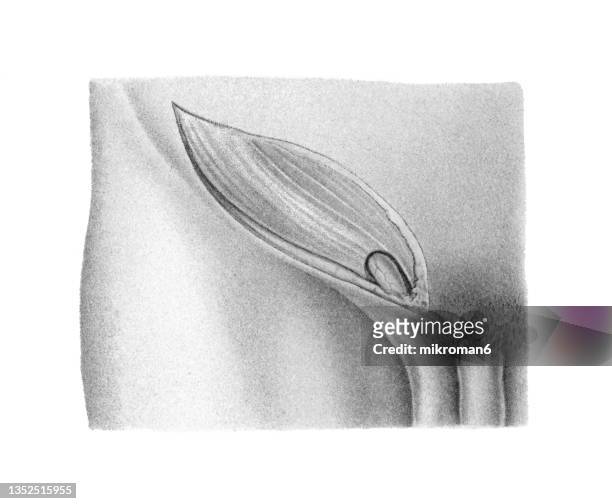 old chromolithograph illustration of surgical operation, inguinal hernia (herniorrhaphy, hernioplasty) - hernia inguinal ストックフォトと画像