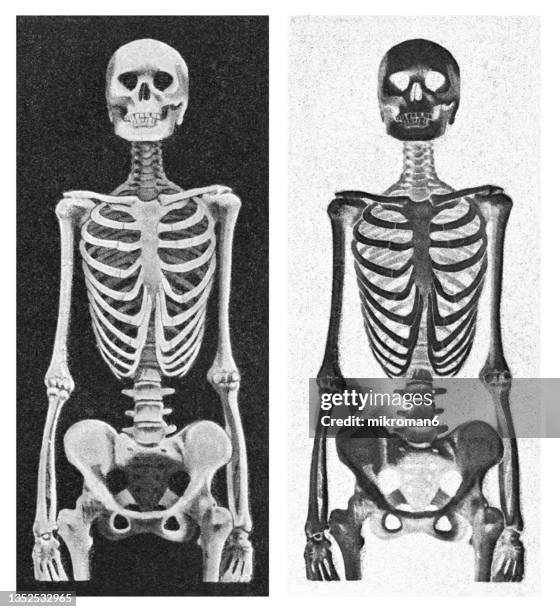 old engraved illustration of a female skeleton deformed by wearing a corset - orthopedic corset stock pictures, royalty-free photos & images