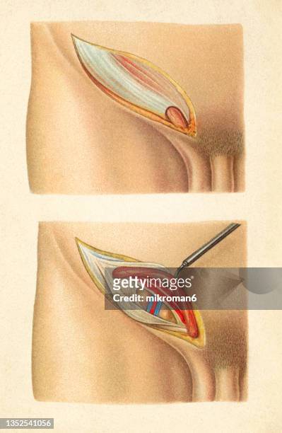 old chromolithograph illustration of surgical operation, inguinal hernia - hernia inguinal ストックフォトと画像