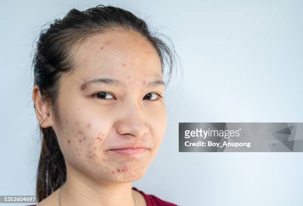 asian woman having stress cause of acne inflamed on her face. - oily skin stock pictures, royalty-free photos & images