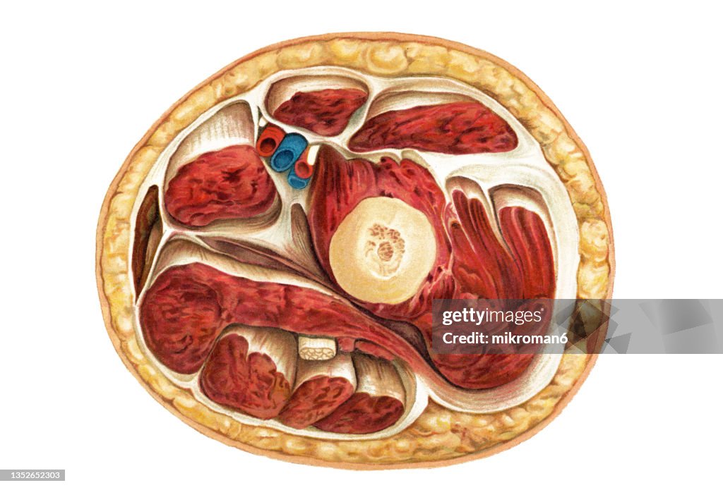 Old chromolithograph illustration of surgical operation, upper arm cross-section