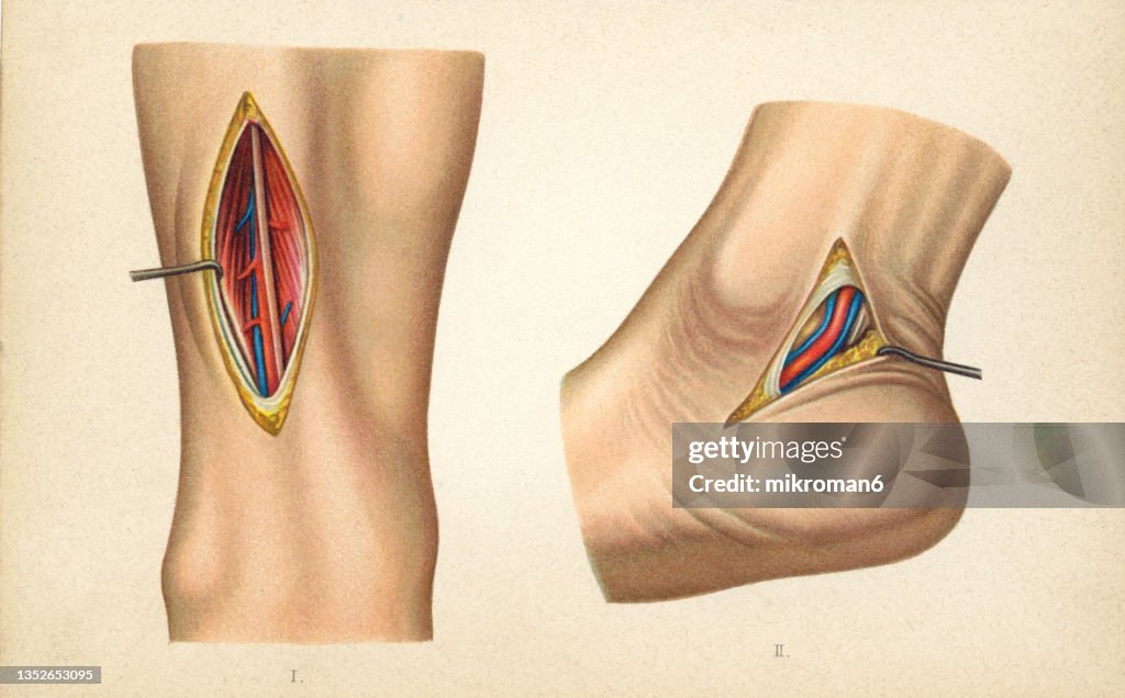 Old chromolithograph illustration of surgical operation, tibial and heel artery