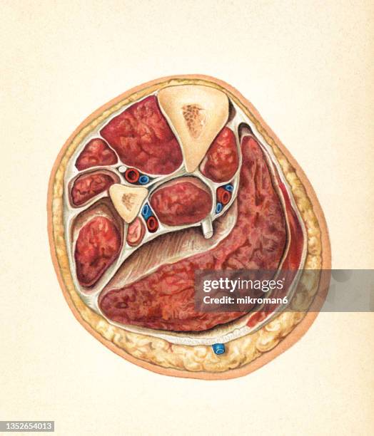 old chromolithograph illustration of surgical operation, cross section of lower leg - ulcer stock pictures, royalty-free photos & images