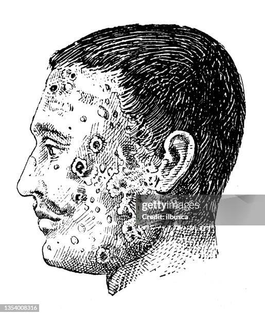 antike illustration: impetigo - impetigo stock-grafiken, -clipart, -cartoons und -symbole