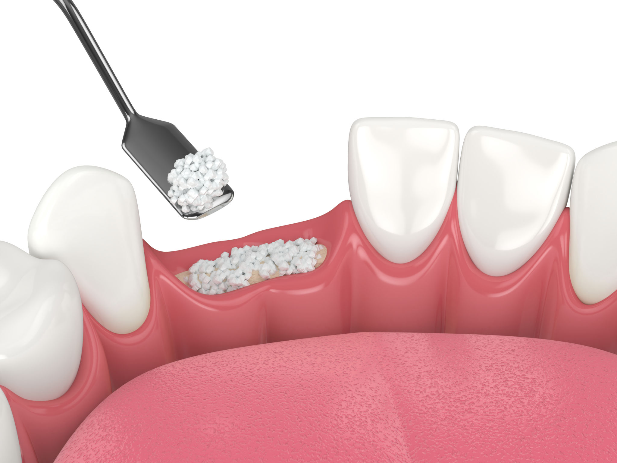 bone grafting