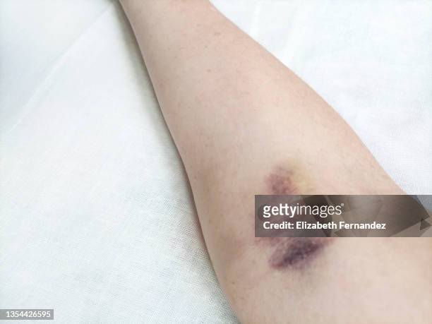 purple bruise on the arm from blood collection - bruised finger stock-fotos und bilder