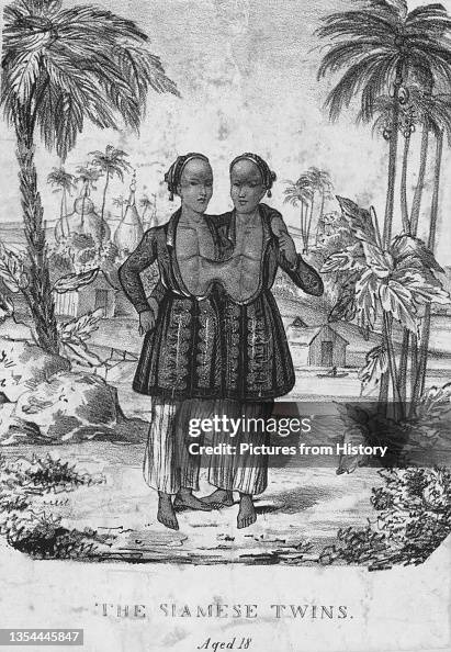 The Most Famous Pair Of Conjoined Twins Was Chang And Eng Bunker the-most-famous-pair-of-conjoined-twins-was-chang-and-eng-bunker