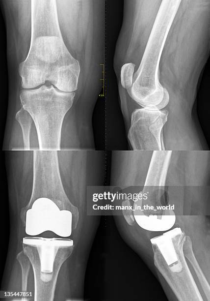 insgesamt knie ersatz, vor und nach dem - künstliches kniegelenk stock-fotos und bilder