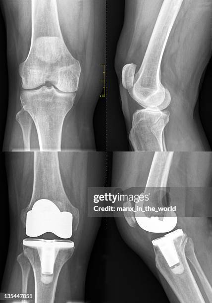 insgesamt knie ersatz, vor und nach dem - knee surgery stock-fotos und bilder