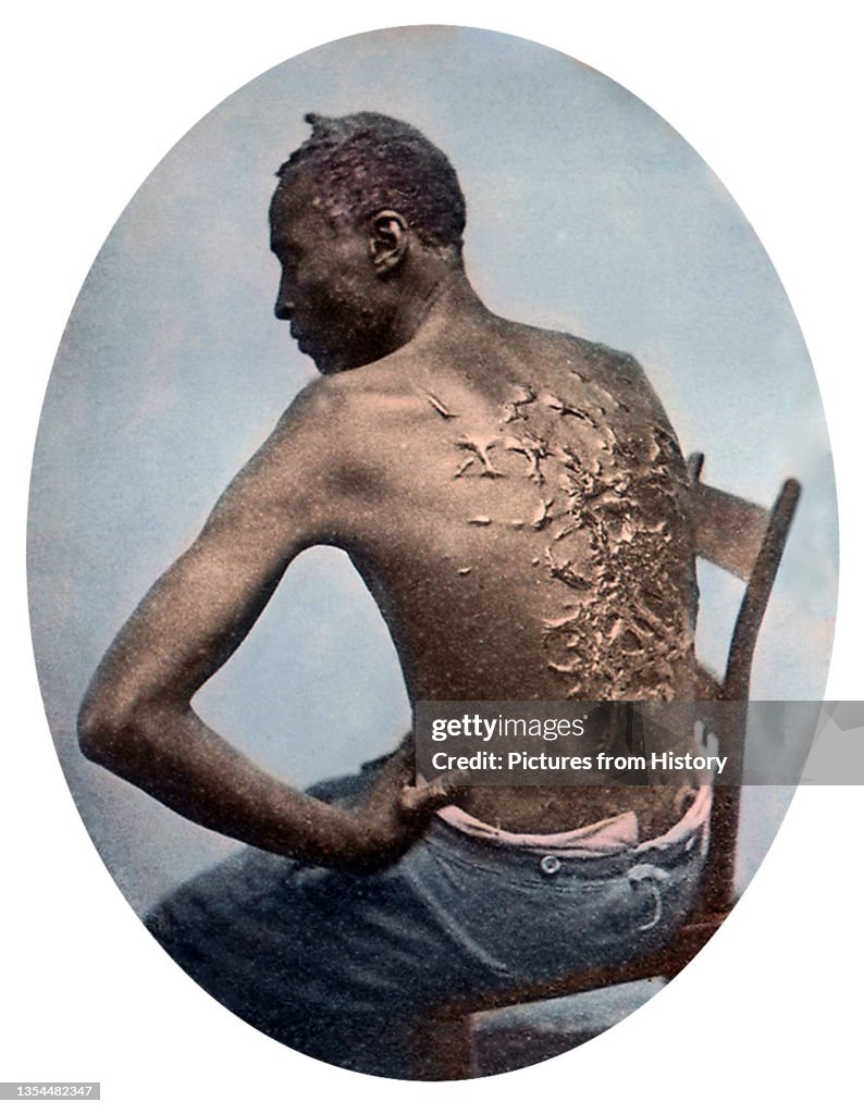 Rear View of Former Enslaved Man Revealing Scars at Medical Inspection
