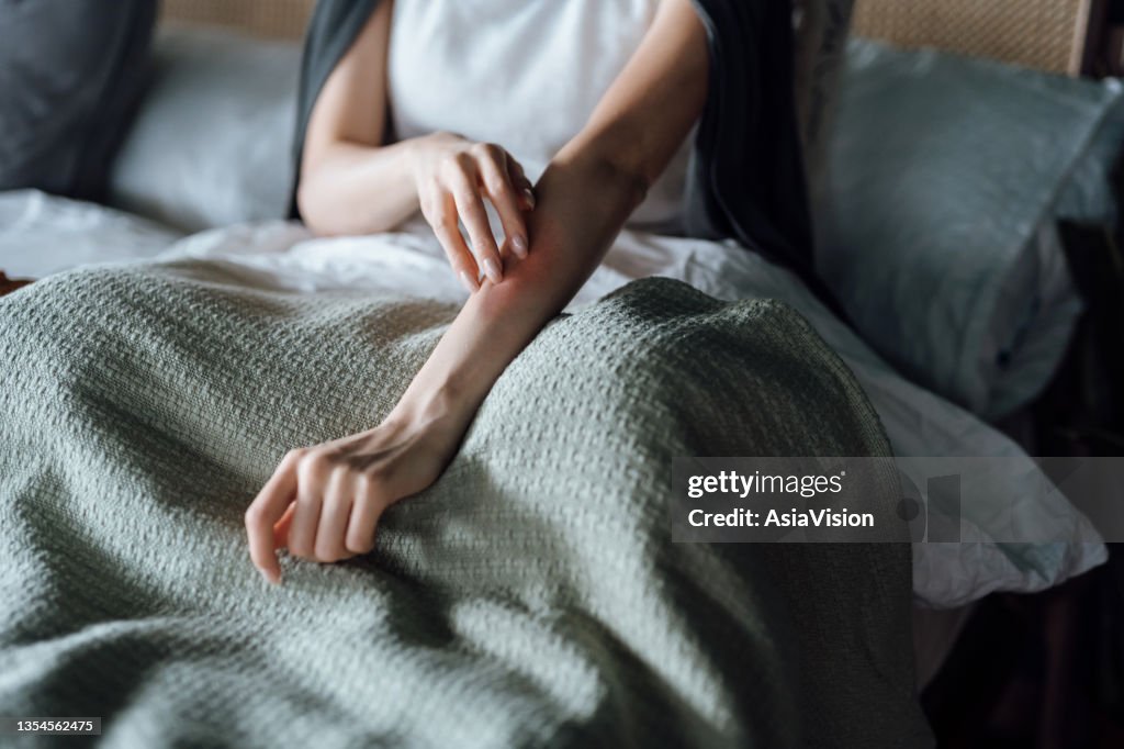 皮膚アレルギーに苦しむ若い女性のクロップドショット, 指で彼女の前腕を掻く