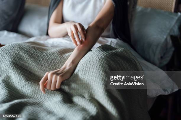 cropped shot of young woman suffering from skin allergy, scratching her forearm with fingers - emotional stress stockfoto's en -beelden