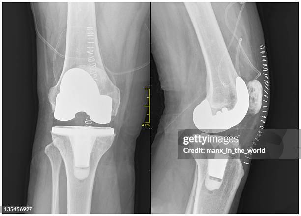 artroplastia total de la rodilla - sutura fotografías e imágenes de stock