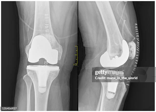 joelho de reposição total - knee replacement surgery - fotografias e filmes do acervo