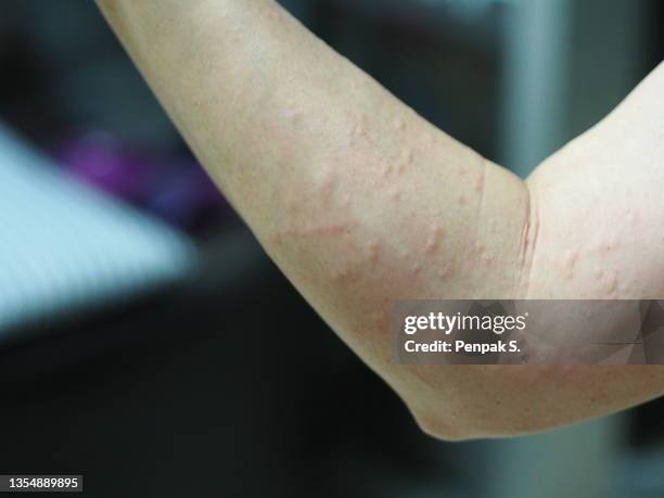 Rash Arm Rash Skin Rash Arm Stock-Fotos und Bilder - Getty Images