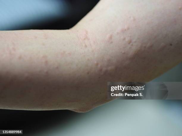 Arm Put Rash Skin Rash Arm Stockfoto's en -beelden - Getty Images