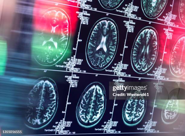 human brain scan in neurology clinic - nuclear medicine stock pictures, royalty-free photos & images