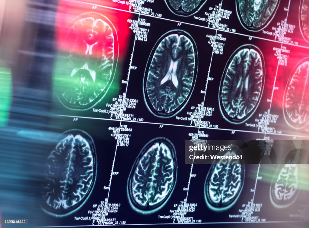 Human brain scan in neurology clinic