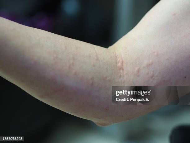 Word Skin Rash 52 Skin Rash Leg Stock Photos, High-Res Pictures, and Images - Getty Images