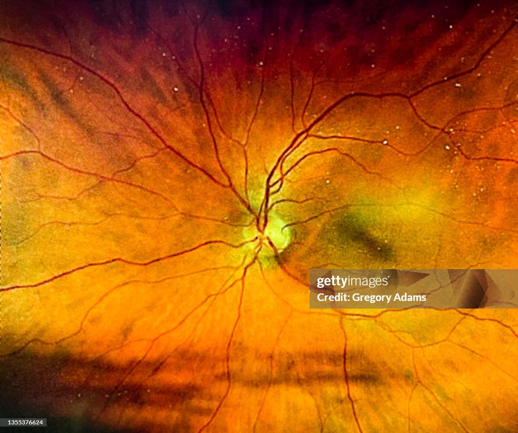 An image of a human retina taken during an eye exam