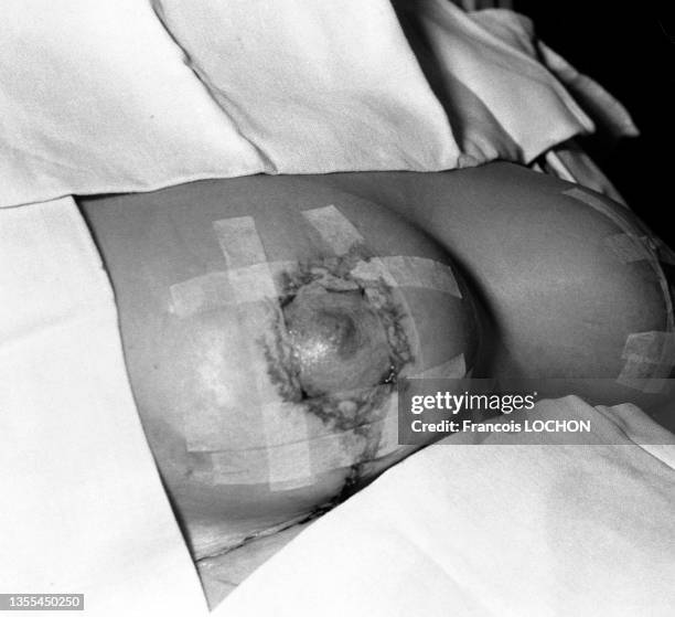 Poitrine d'une femme suite à une opération de chirurgie esthétique des seins en mars 1975 à Paris.