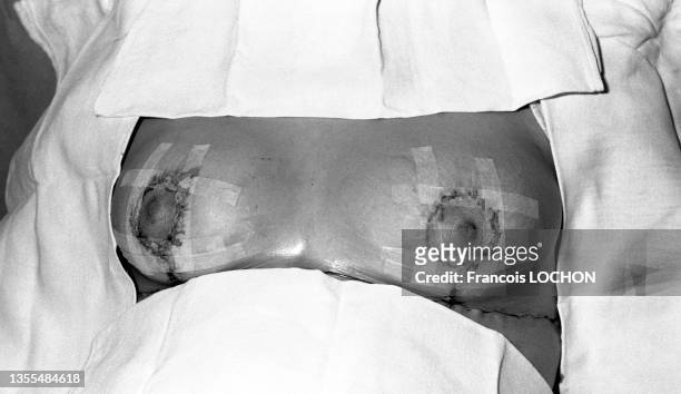 Poitrine d'une femme suite à une opération de chirurgie esthétique des seins en mars 1975 à Paris.
