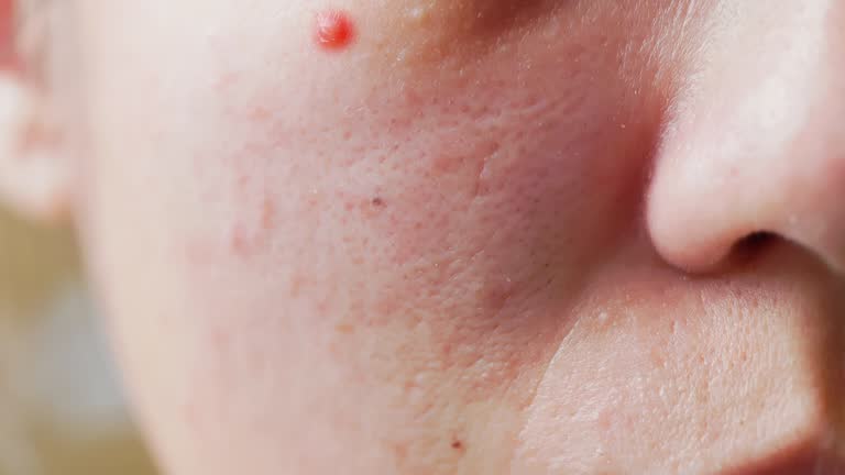 Exploding Infected Pimples 500 Infected Pimples Stock Videos, Footage, & 4K Video Clips - Getty Images