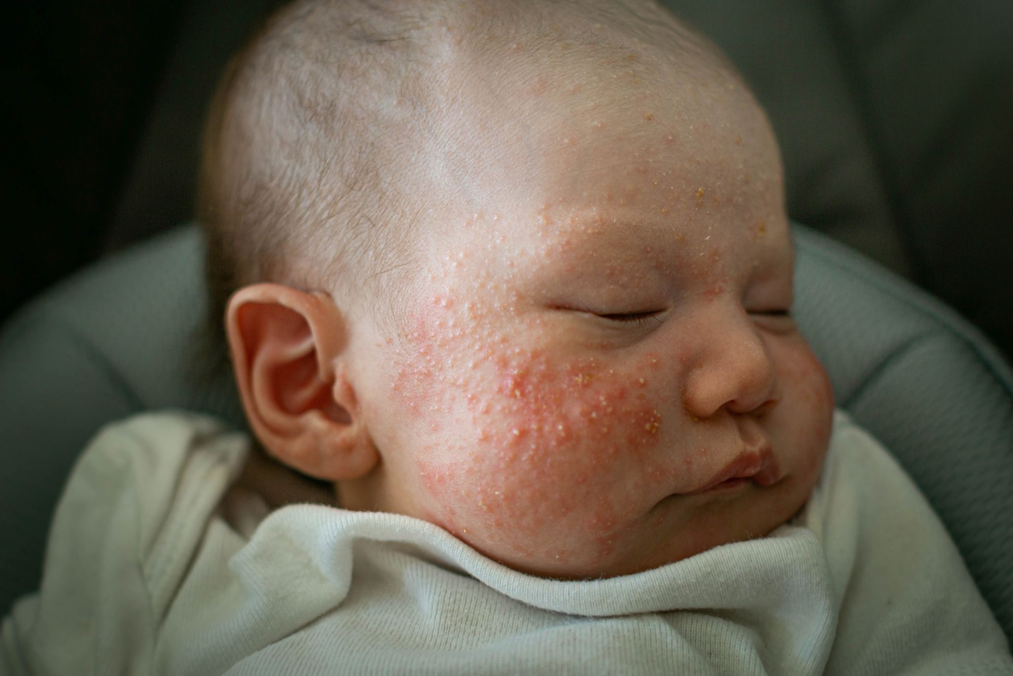 heat rash baby