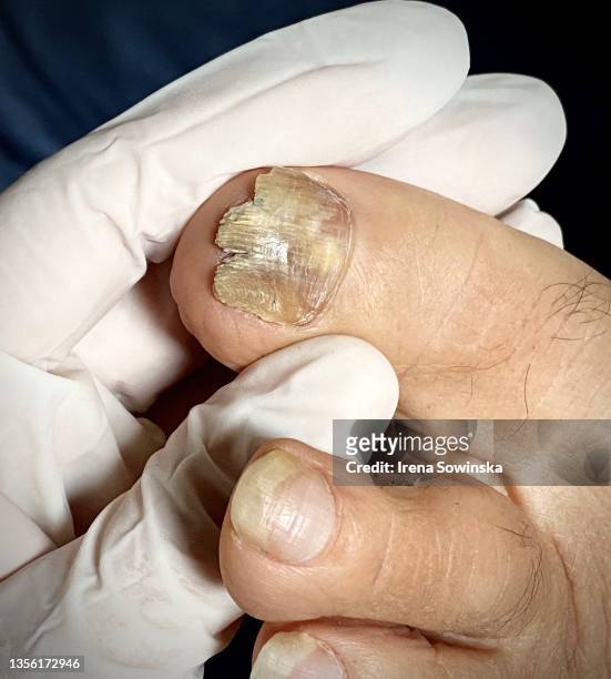onicomicosi - images of ugly feet stock pictures, royalty-free photos & images