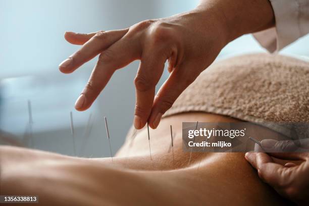 tratamento de volta da acupuntura - acupuncture - fotografias e filmes do acervo