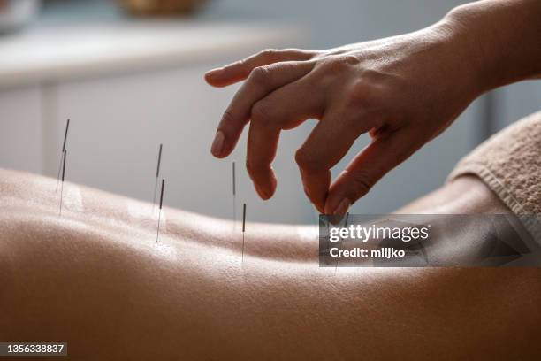 acupuncture back treatment - acupuncture stock pictures, royalty-free photos & images