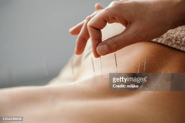 traitement du dos par acupuncture - acupuncture photos et images de collection