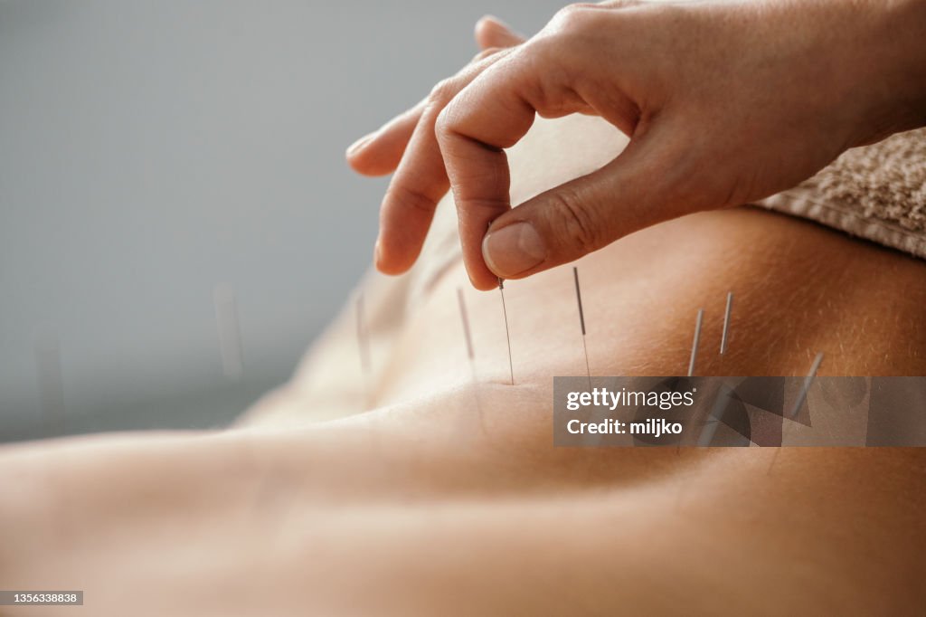 Acupuncture back treatment