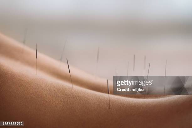 akupunktur rückenbehandlung - acupuncture stock-fotos und bilder