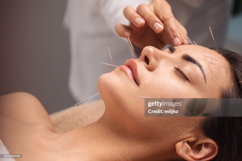 Acupuncture face treatment