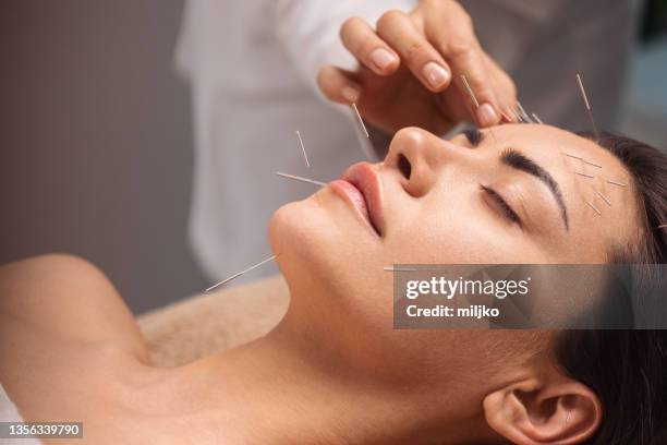 acupuncture face treatment - acupuncture stockfoto's en -beelden