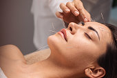 Acupuncture face treatment