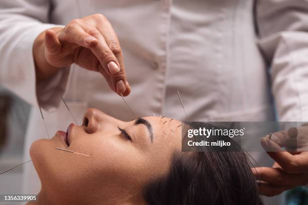 acupuncture face treatment - acupuncture stockfoto's en -beelden
