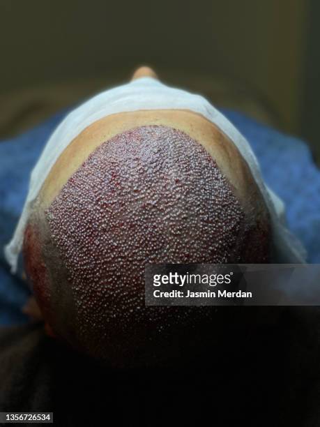 hair transplant - haartransplantation stock-fotos und bilder