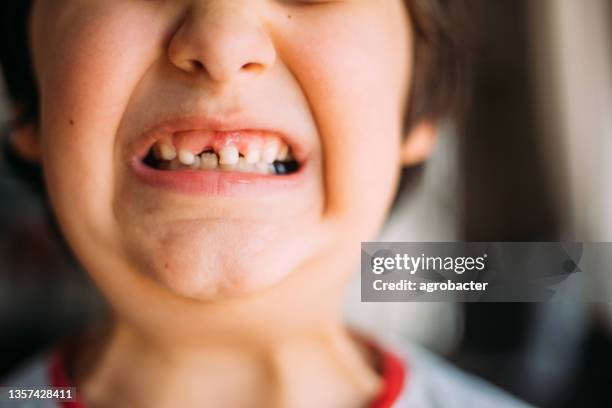 Lost Front 158 Happy Boy Missing Front Teeth Stock Photos, High-Res Pictures, and ...