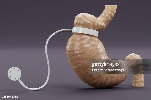 Apollo Endosleeve vs. Traditional Bariatric Surgery: Pros and Cons