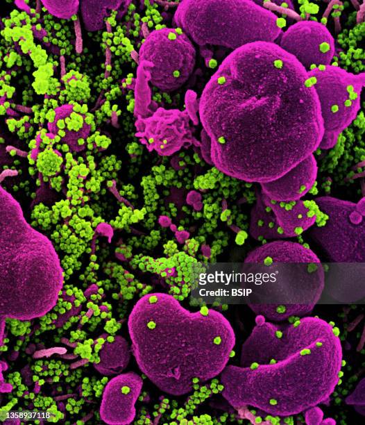 Colorized scanning electron micrograph of an apoptotic cell heavily infected with SARS-CoV-2 virus particles , isolated from a patient sample. Image...